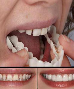 لمینت دندان دو فک مدل Snap on Smile